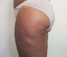 cellulite treatment nyc before